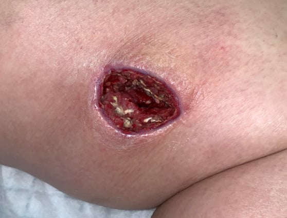 wound ngs study