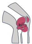 ortho knee infection