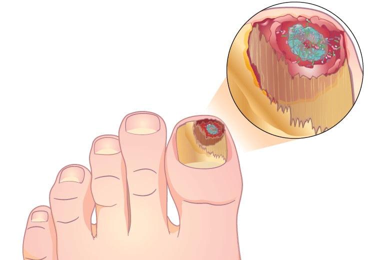 toenail infection